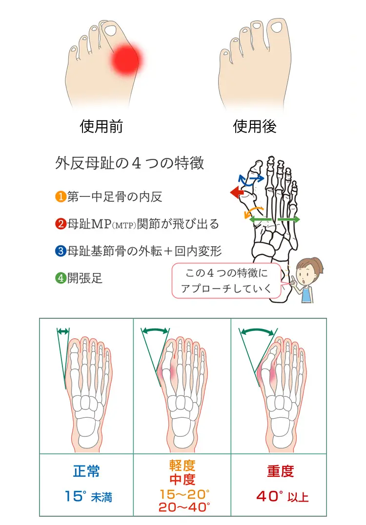 日本整形外科專業醫生推薦 硅膠外翻母趾矯正器 溫柔保護脚趾